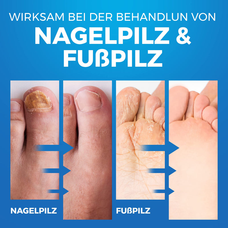 Nail fungus and athlete's foot spray | Shoe Spray Antibacterial | Nail fungus spray shoes | 150ML - NewNest Australia