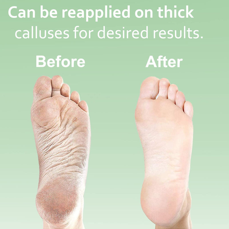 Dr. Entre's Callus Remover for Feet: 8oz Callus Remover Gel, Foot File, Pumice Stone, 5 Glove Pairs, Corn Remover for Feet, Spa Kit, Foot Callus Remover, Corn Removal Treatment - NewNest Australia