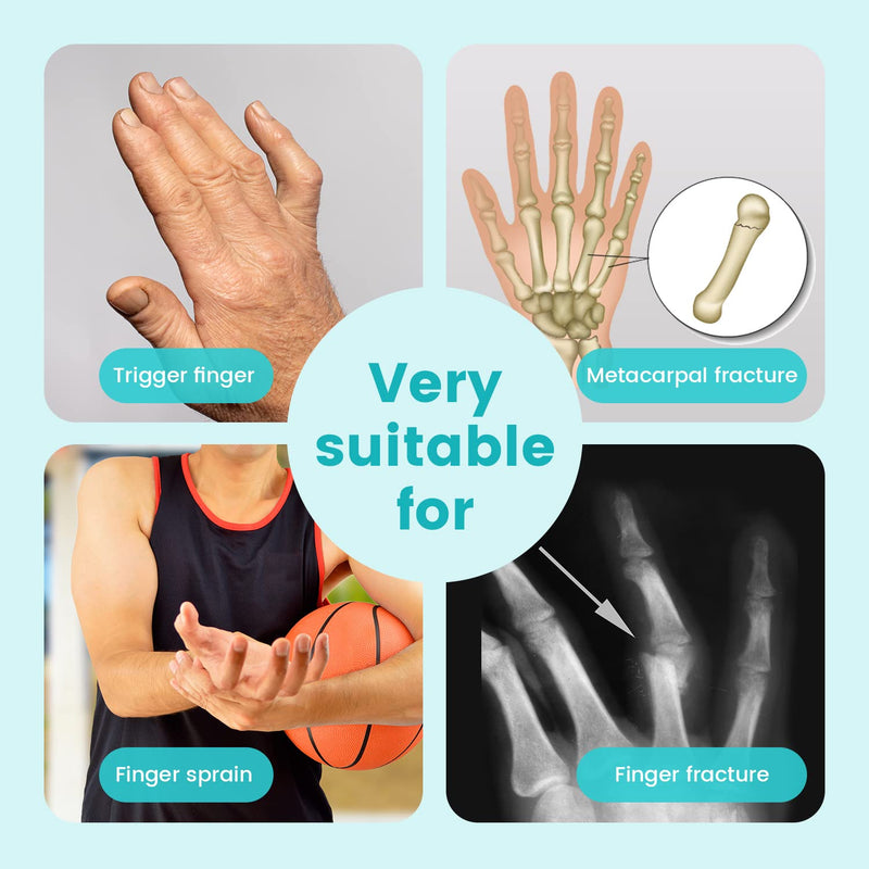 Fingers Splint,Adjustable Finger & Metacarpal Brace, 2 Aluminum Plate Support,Trigger Finger Splint, Finger Correction Immobilizer, Finger Fracture, Arthritis, Mallet Finger, Sprain (2-Fingers) 2-Fingers - NewNest Australia