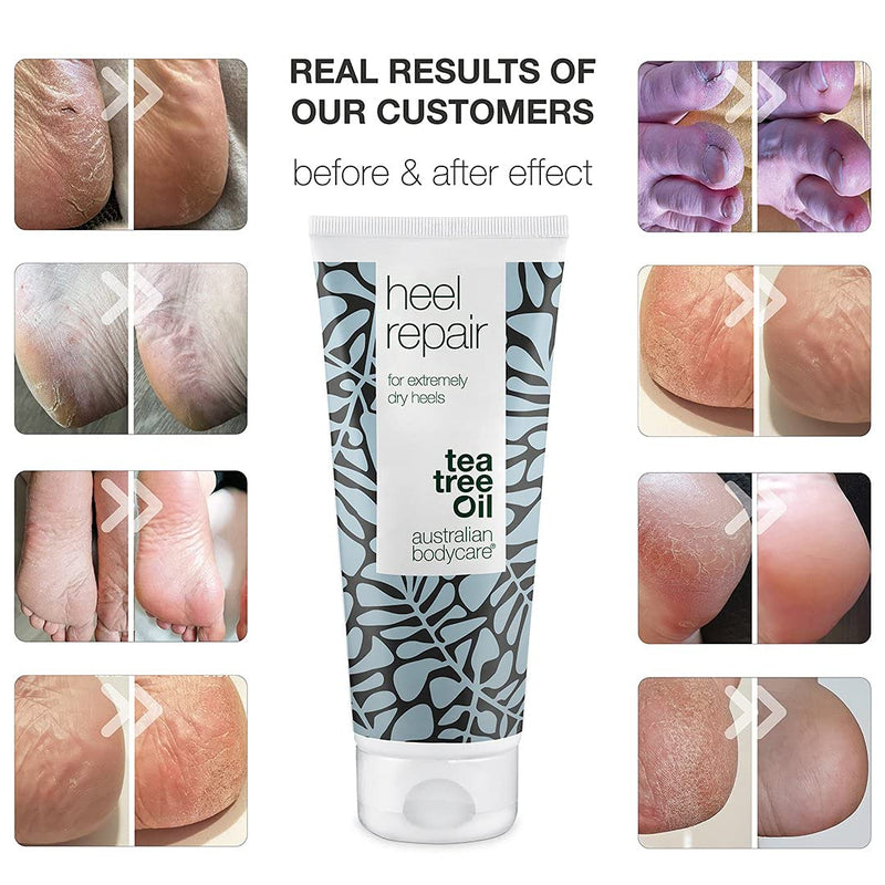 Australian Bodycare Cracked Heel Repair Cream 100ml | Hard Skin Remover for Feet | 25% Urea Cream | Cracked Heel Balm | Heel Care for Women & Men with Dry and Cracked Feet | Australian Tea Tree Oil 100 ml (Pack of 1) - NewNest Australia