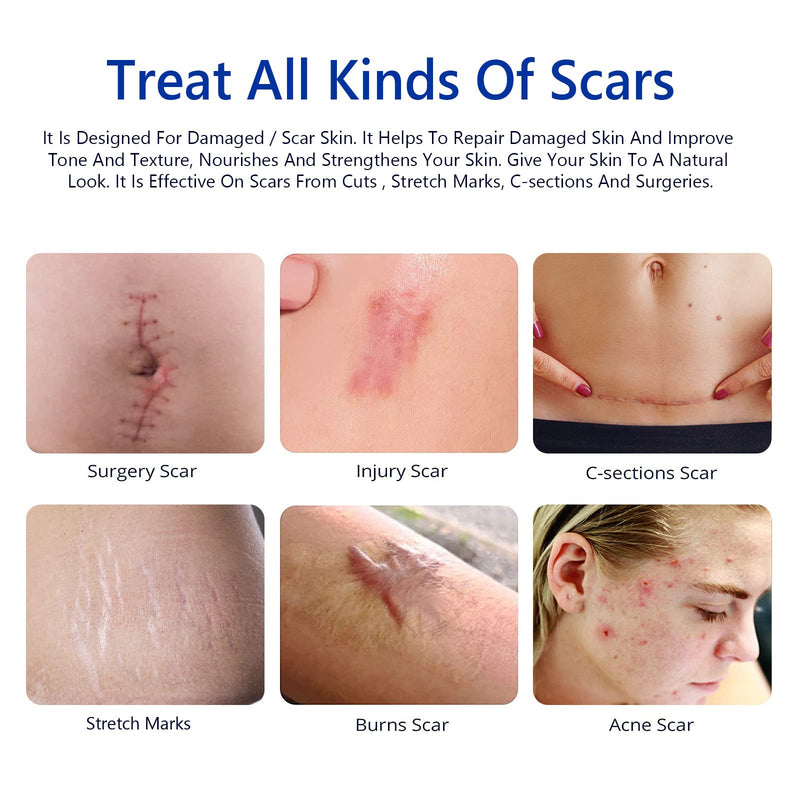 Scar Removal Cream,Rapid Repair of New and Old Scars,Soften and Flattens Scars Resulting from Surgery, Injury, Burns, C-Section et, Natural Scar Treatment for Women&Men - NewNest Australia