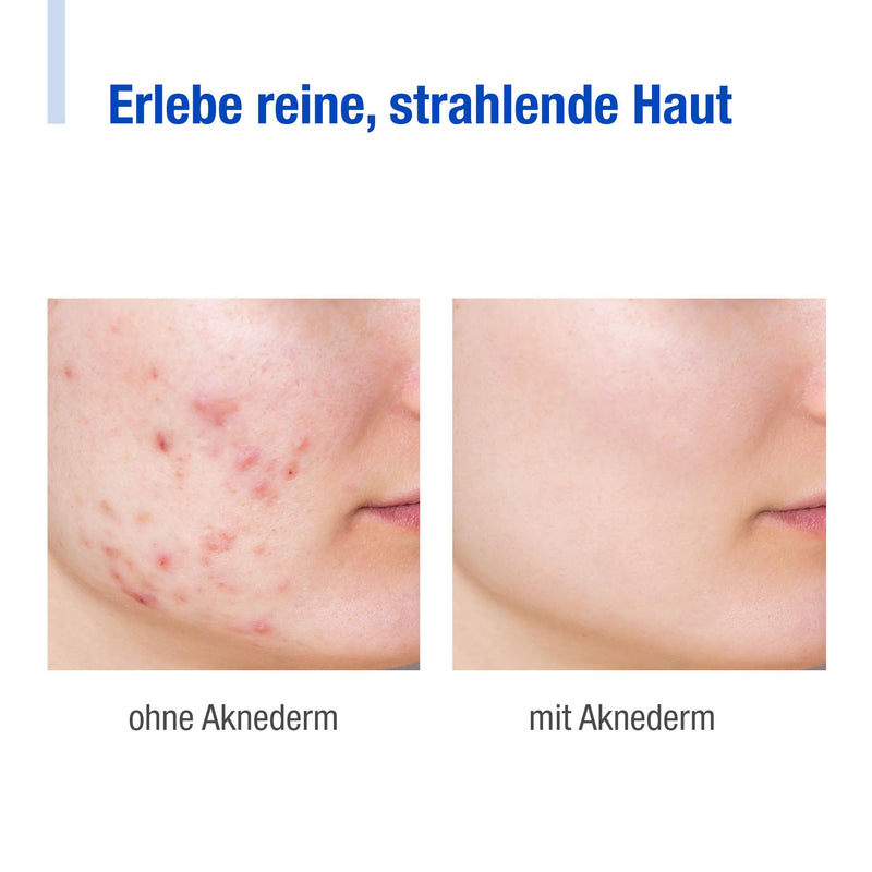 Acnederm Cream Intens 30g for all skin types - anti-inflammatory anti-pimples with zinc - sebum-regulating acne provides moisture - mattifying against pimples - without perfume 30 g (pack of 1) - NewNest Australia