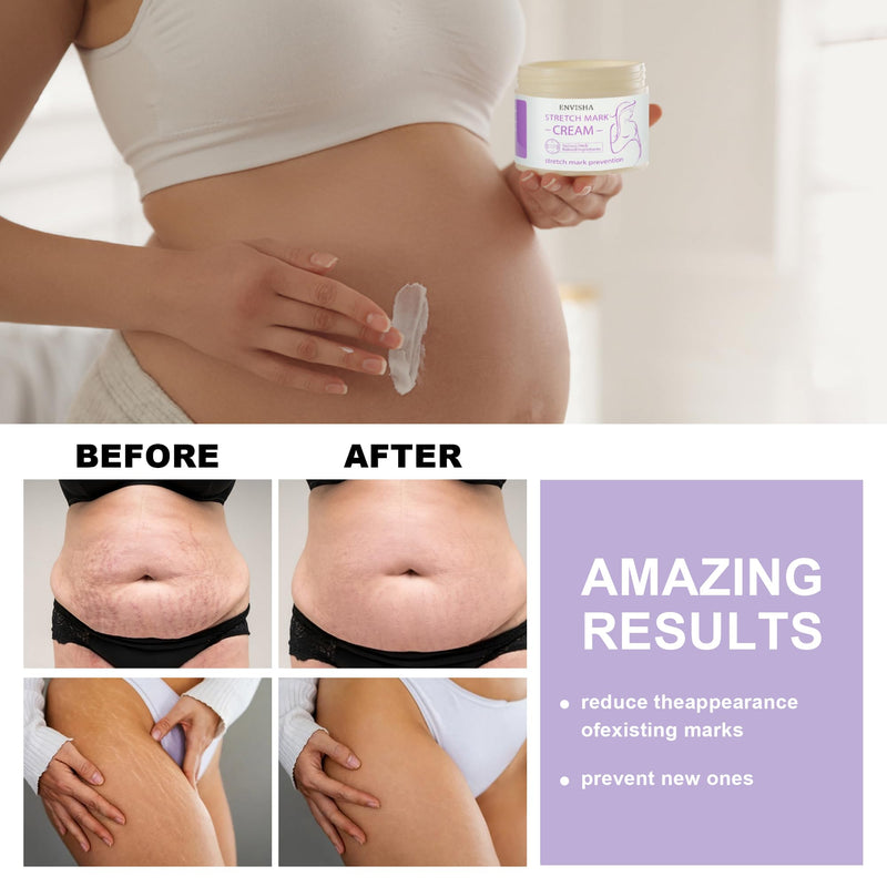 Stretch Marks Scar Cream, Restore Elasticity, Repair Scar Slack Line Belly Stretch Marks After Birth, Maternity Stretch Marks Cream - NewNest Australia