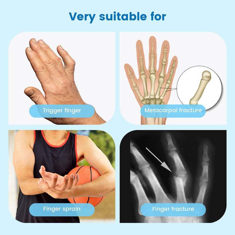 Finger Splint Finger Support, Finger And Metatarsal Splints, Adjustable Finger Orthosis, Aluminum Plate Support For Boxer Fracture, Sprains, Arthritis, Tendonitis, Trigger Fingers (2 Fingers) - NewNest Australia