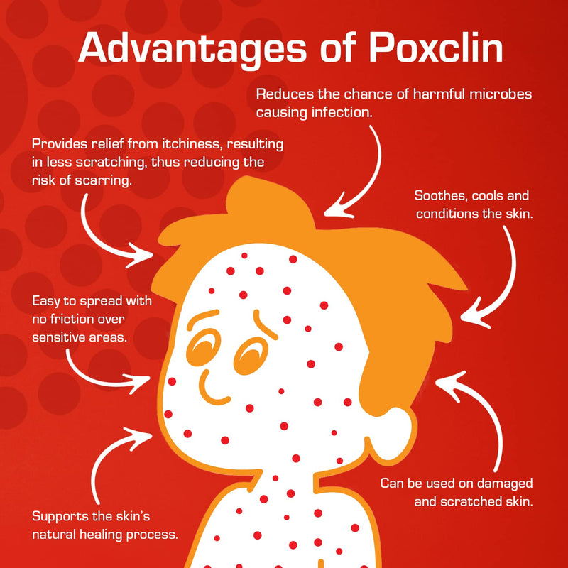 PoxClin CoolMousse Chicken Pox Treatment for Children - Chicken Pox Relief Kids - Relieve Symptoms and Itch of Chickenpox - Natural Ingredients - Cool Mousse Chicken Pox Cream Alternative - 100 ml - NewNest Australia