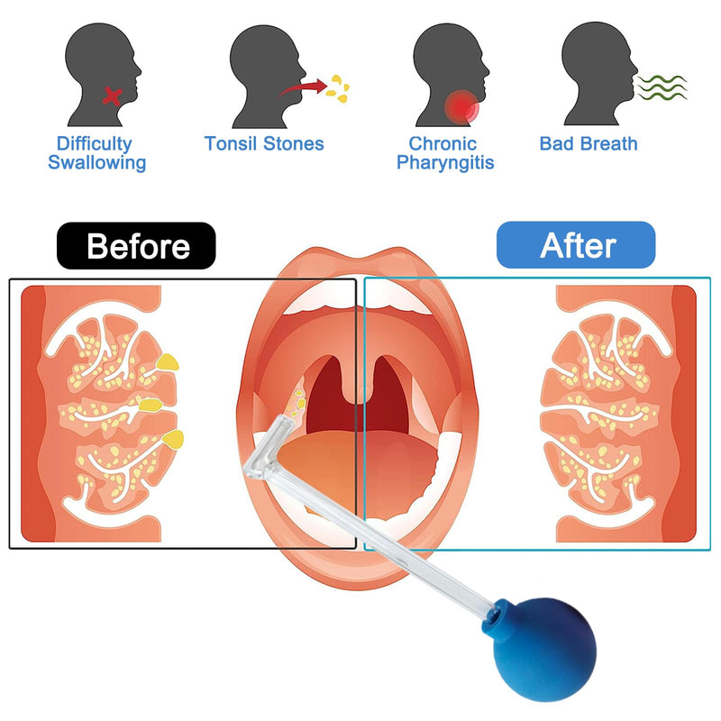 Tonsil Stone Remover for Fresh Breath 2 Pcs Tonsil Stone Remover Tonsil Stone Remover Vacuum Tool Tonsil Stone Removal Tool Cupping Glass Tonsil Clean with Tonsil Stone Remover - NewNest Australia