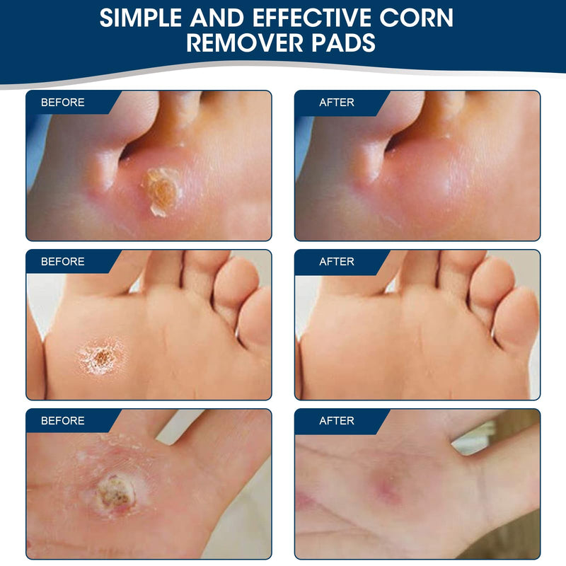 MYMULIKE 60 Count Corn Plasters, Remover Corns for Feet, Corn Soothing and Foot Care Stubborn Corns Remove Sole of Foot - NewNest Australia