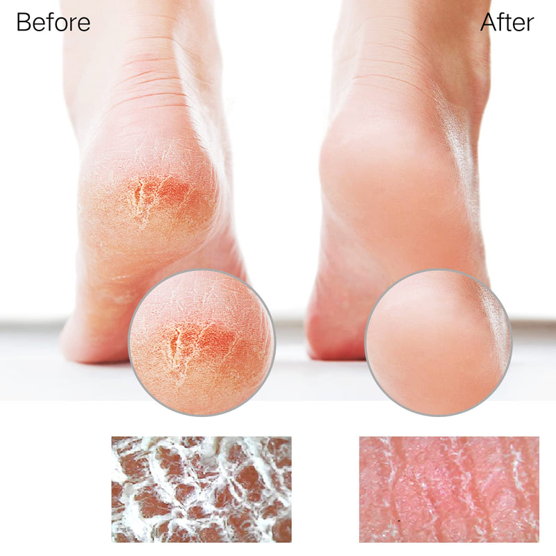 Sunivaca Nano Glass Callus Remover - Soft And Smooth Feet Professional Foot Care, Callus Removal Wet & Dry - Callus File For Velvety Soft Baby Feet Safe & Quick - NewNest Australia