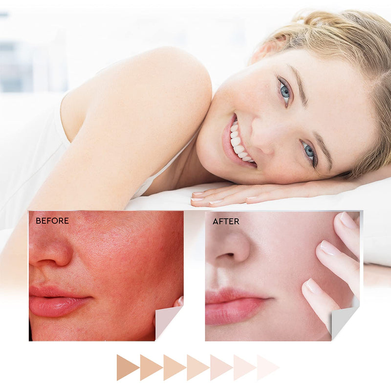Recuren Plus Healing Max Cream Max Strength for Dermatitis Eczema Psoriasis Athletes Foot Jock Itch Urticaria Rash Rosacea Acne Ultimate Anti-Itch Solution - NewNest Australia