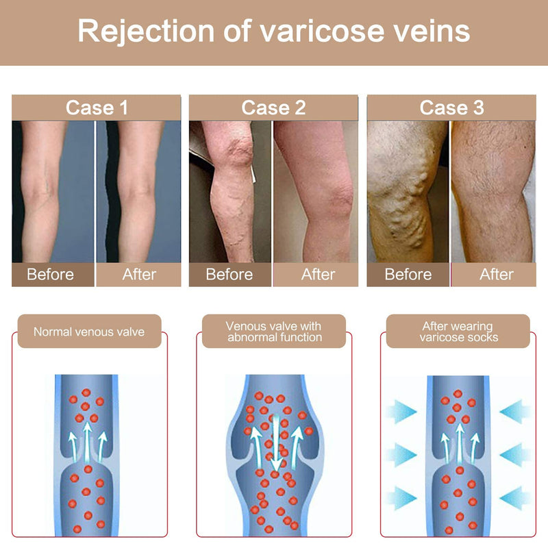 YISEMEYA 2 pairs of medical compression stockings for women, long, 20-30 mmHg support stockings for women, opaque toe wrap compression tights for women, great support for varicose veins, edema L beige and black - NewNest Australia
