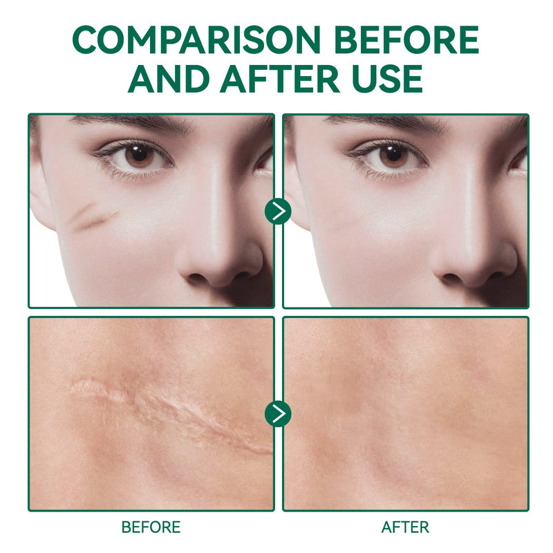 Silicone Scar Gel- Scar Removal Cream Gel, Stretch Mark Cream, Medical Advanced Scar Gel for Old and New Scar, Scar Cream for Surgical Scars, C-Section, Keloid, Acne Scars, Gentle Formula 50ML Green - NewNest Australia