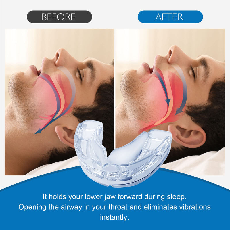 Anti-snoring splint, snoring stopper mouthpiece, effective bite splints, night splint against teeth grinding and snoring for men and women - NewNest Australia