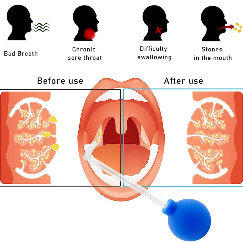 Lets Joy Tonsil Stone Remover for Removing Tonsil Stones, Tonsil Stone Cupping Glass, Tonsil Stone Removal, Tonsil Sucker Tonsil Stone, Tonsil Stone Remove Tools, Fresh Breath Oral Care Blue - NewNest Australia