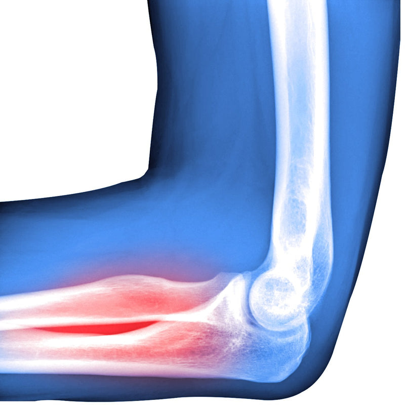 SOLES Tennis Elbow and Golf Elbow Brace (SLS509) - NewNest Australia