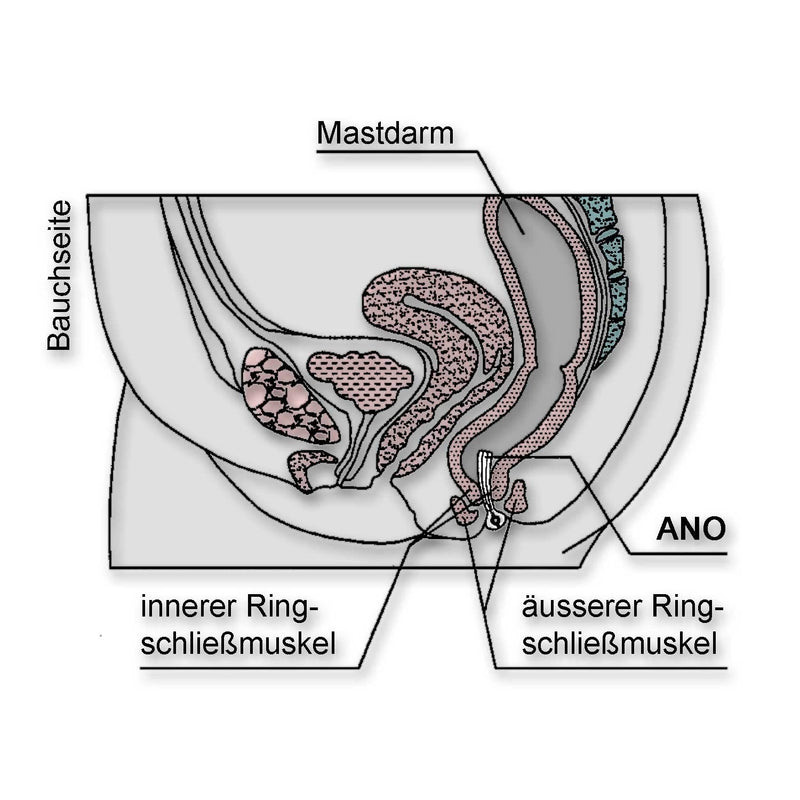Intestinal pessary ANO from Junker® - NewNest Australia