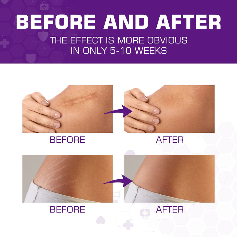 Kelinul Scar Cream-Advanced Silicone Gel for C-Section, Stretch Marks, Acne, Surgery, Effective both Old and New Scars- Advanced Post Supplies-Try Surgical Sheets-1.7 oz - NewNest Australia