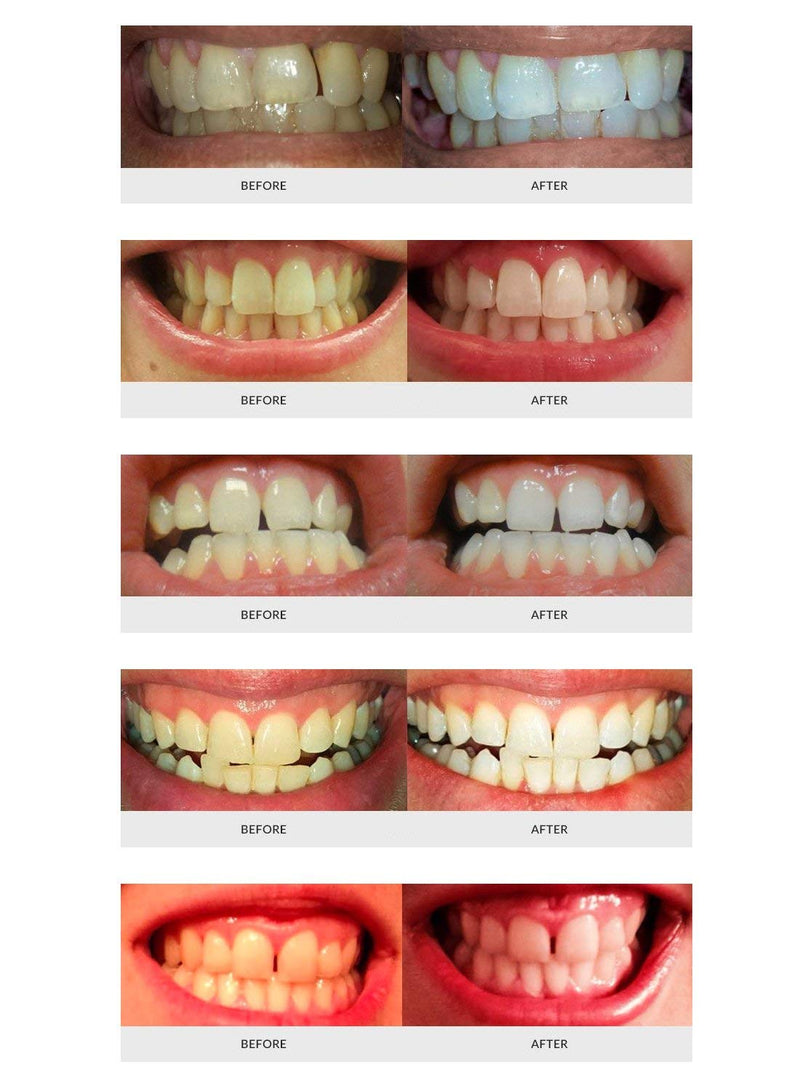 AuraGlow Teeth Whitening Kit, LED Light, 35% Carbamide Peroxide, (2) 5ml Gel Syringes, Tray and Case - NewNest Australia