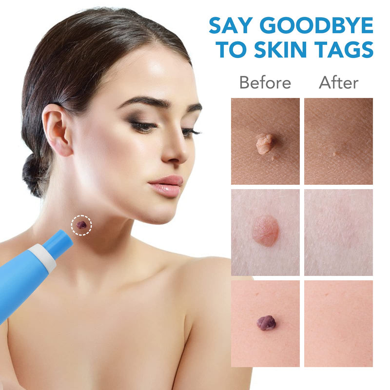 Auto Skin Tag Removal Tool Kit, 2 in 1 Skin Tag Remover Device, 2mm to 8mm Auto Wart Remover, Safe & Painless & Easy Remover Clear Skin Tag & Mole at Home,with 40 Removal Bands & 10 Cleansing Wipes - NewNest Australia