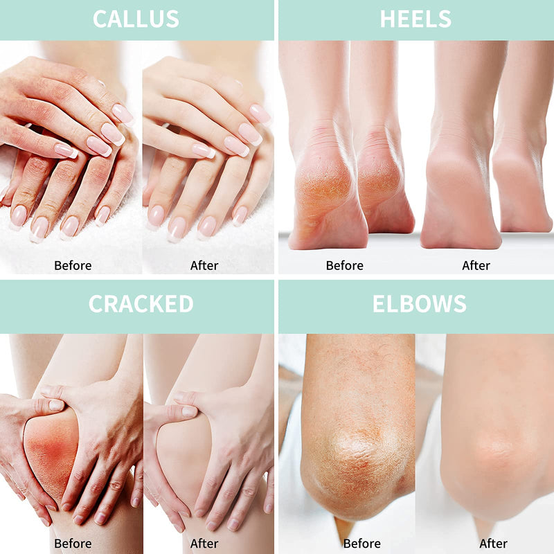 Urea Foot Cream 40 Percent Plus 2% Salicylic Acid 5.29 oz || Urea Cream for Feet with Hyaluronic Acid, Tea Tree, and Aloe Vera for Deep Moisturizing, Callus Remover and Soften 150 g (Pack of 1) - NewNest Australia
