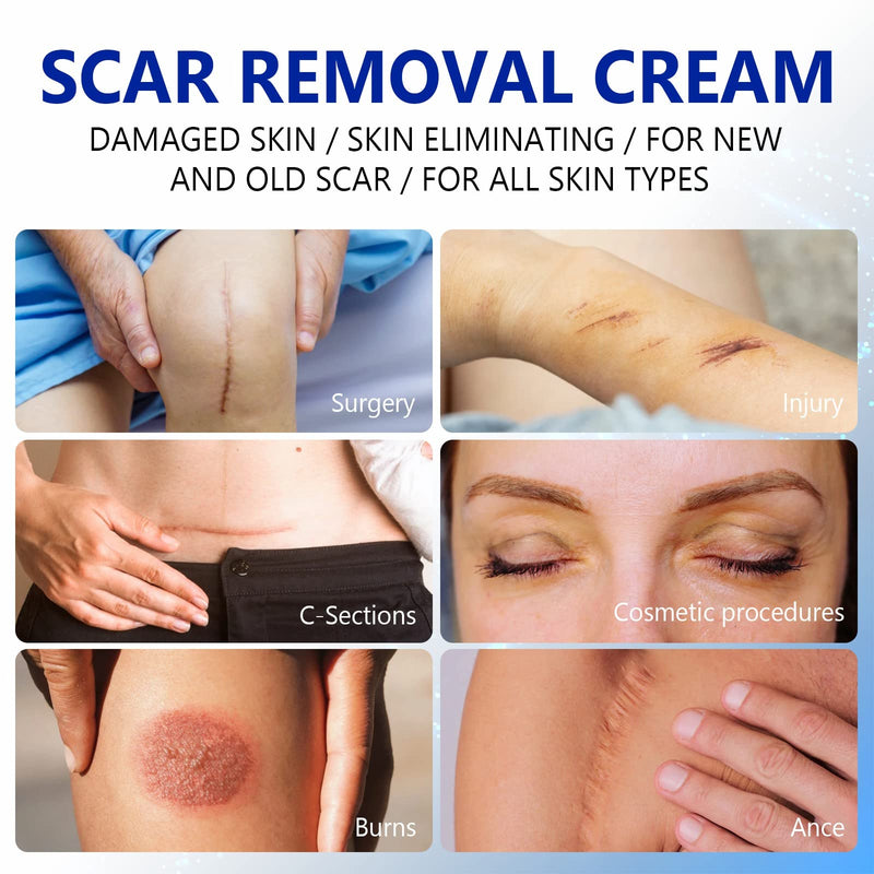 Scar Removal Cream,Rapid Repair of New and Old Scars,Soften and Flattens Scars Resulting from Surgery, Injury, Burns, C-Section et, Natural Scar Treatment for Women&Men - NewNest Australia