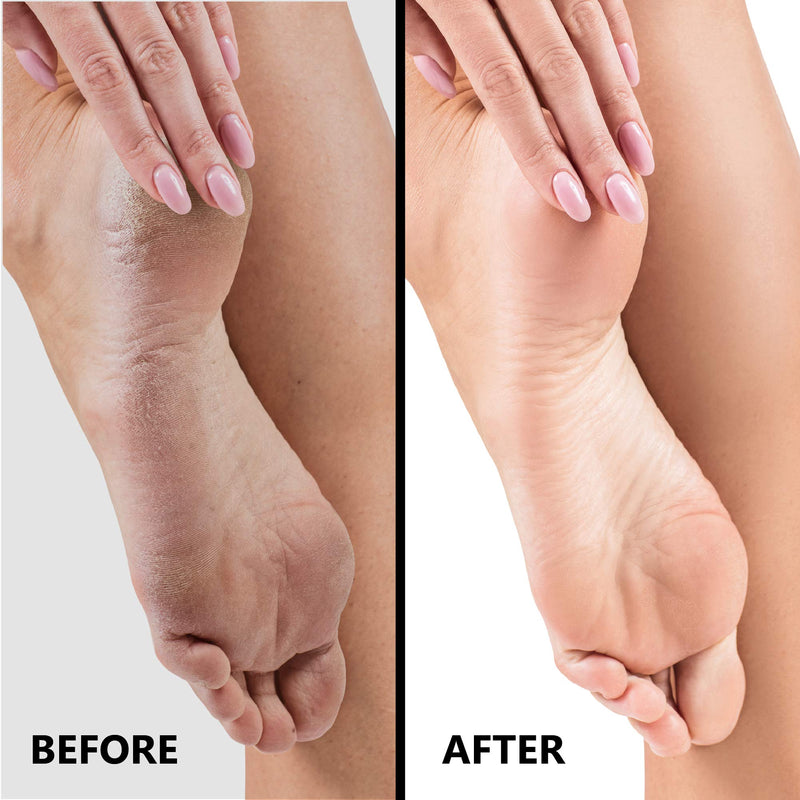 SlkySmooth 3-in-1 Foot File | Hard Dead Skin Remover | Cracked Heels Callus Pedicure Scrubber Corn Removal | Scraper Grater Pumice Stone Exfoliator Rasp Pedi Exfoliating Heel Files for Feet Care - NewNest Australia