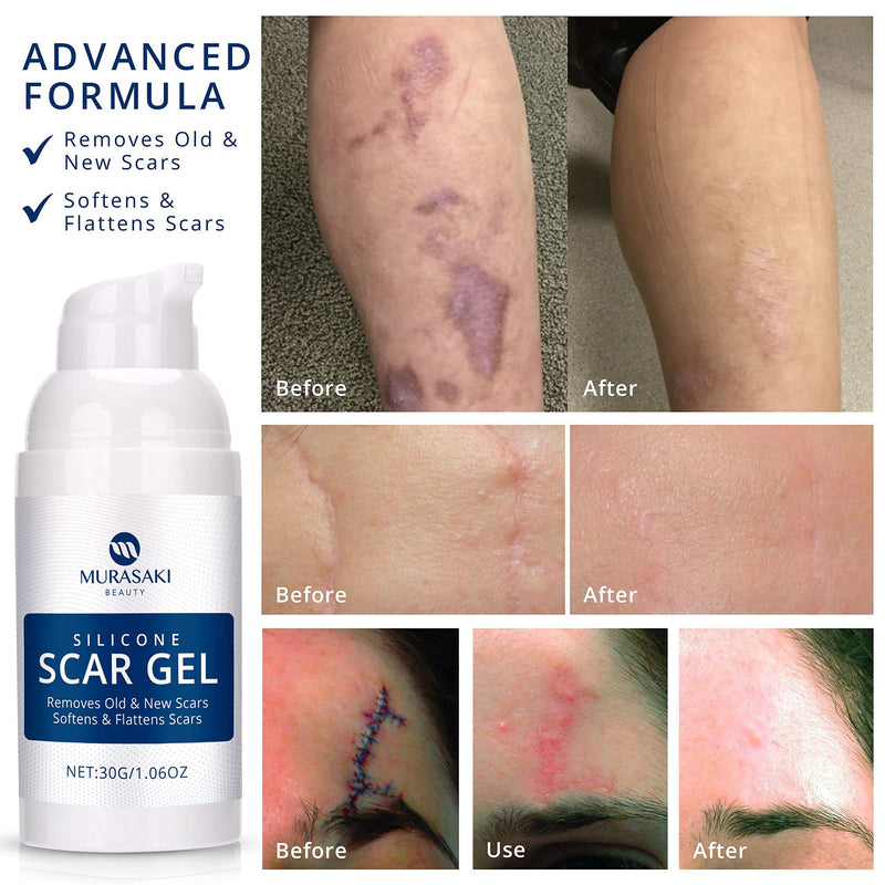 Scar Gel silicone scar gel from C-Section, Stretch Marks, Acne, Surgery, Effective for both Old and New Scars - NewNest Australia