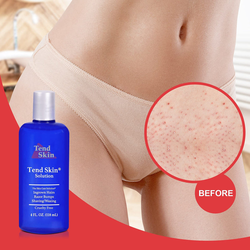 Tend Skin Womens AfterShave/Post Waxing Solution for Ingrown Hair, Razor Bumps and Razor Burns, 4 ounce, Blue 4 Fl Oz (Pack of 1) - NewNest Australia