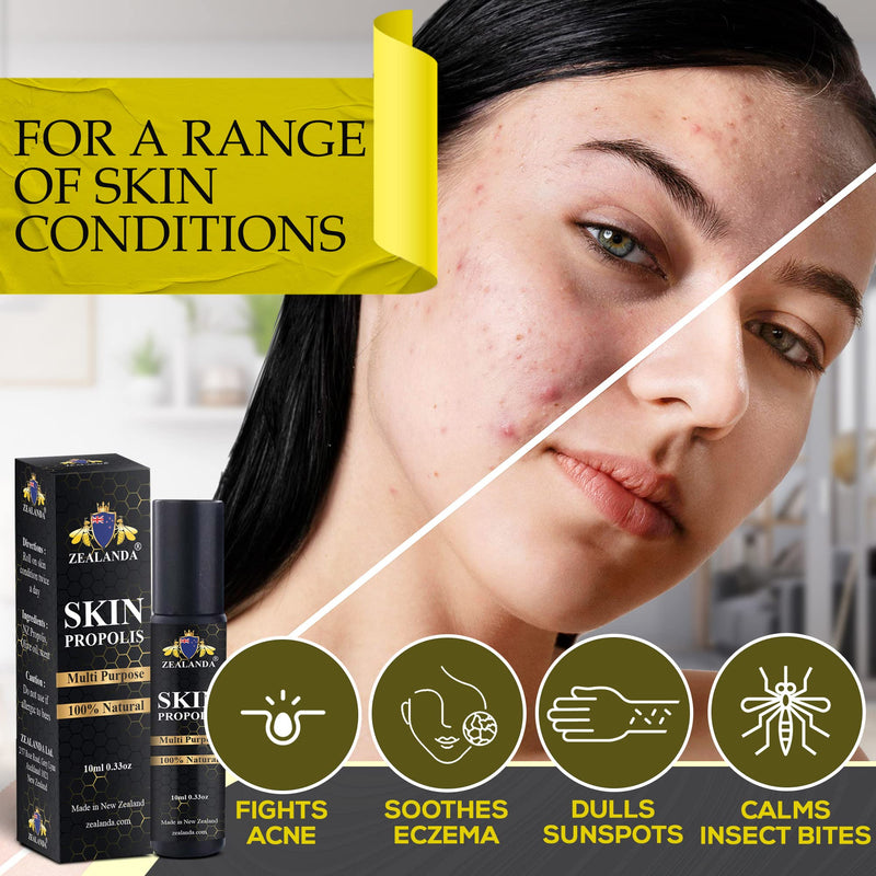 ZEALANDA Skin Propolis, Multi Purpose 100% Natural No Alcohol Treatment for Acne, Pimple, Eczema, Callus, Sunspot,Skin Rash, Insect Bites, Cuts & Wounds. Made & Packed in New Zealand - NewNest Australia