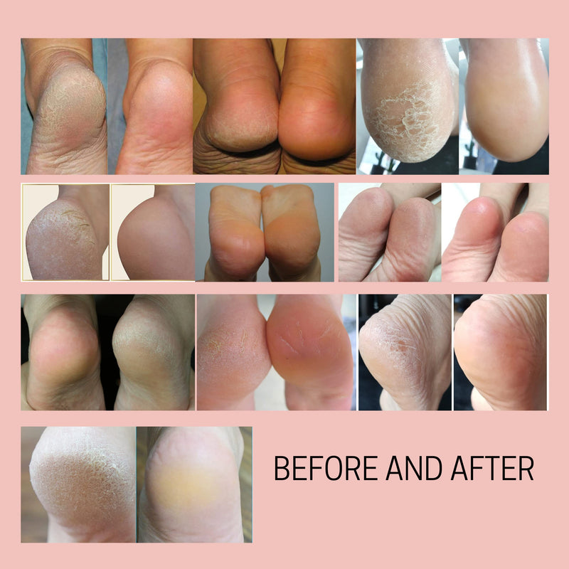 Callus Remover - Three Minutes Quick Fix- Foot File Rasp - Instant Foot Exfoliating Softener Peel Spray, Heels Callus Scrubber File - Home Spa Pedicure Treatment. Wonder Pedi (Foot File+Softner) Foot File + Softener - NewNest Australia