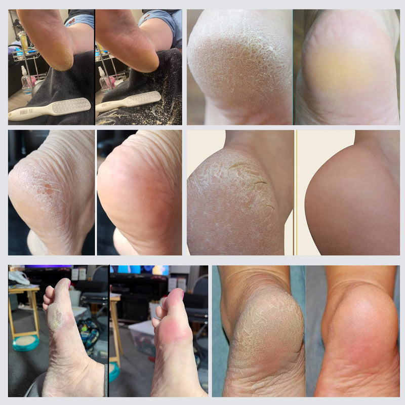 Callus Remover - 3 Minutes Quick Fix - Foot File Rasp - Instant Foot Exfoliator, Emollient, Exfoliating Spray, Heels, Callus, Scrubber File - Home Spa Pedicure Treatment Wonder Pedi - NewNest Australia