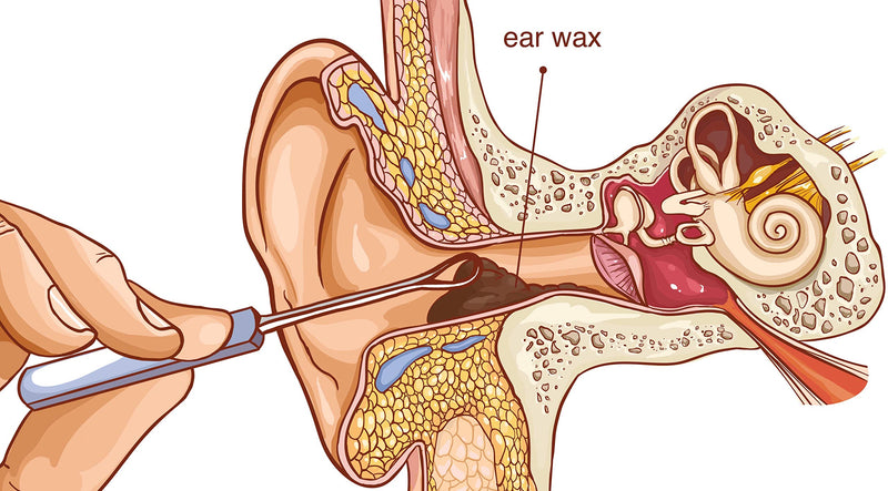 REMOS ear cleaner made of stainless steel to remove earwax, length 7 cm - NewNest Australia