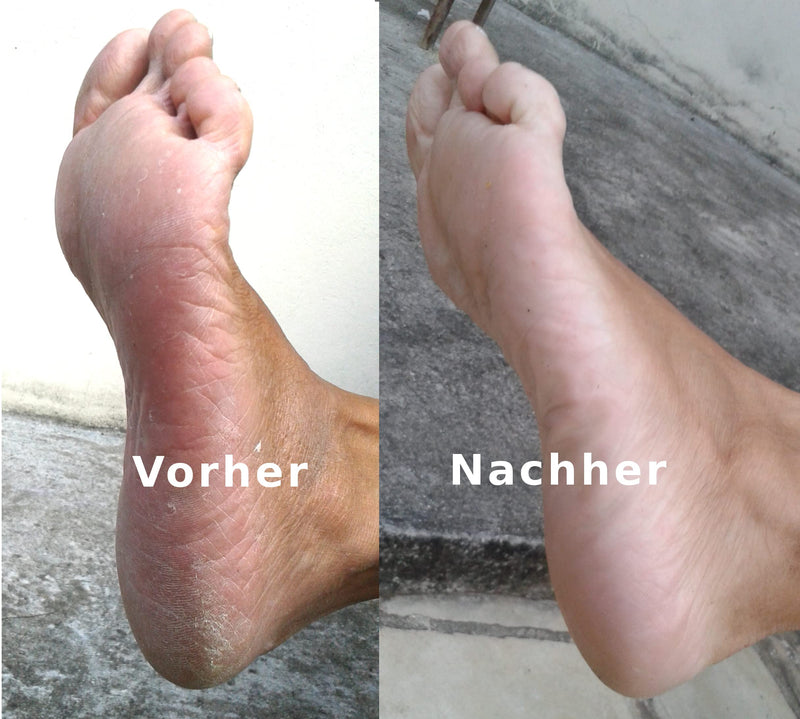 Mosadal foot tub Removal of calluses from the feet is easy and hassle-free - NewNest Australia