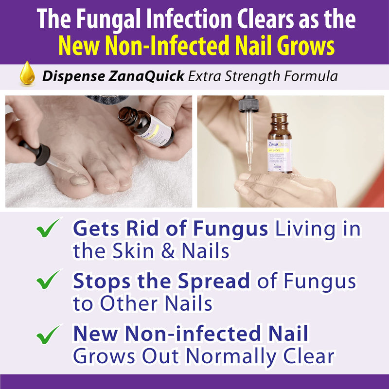 ZanaQuick Toenail Fungus Treatment Drops - 2 Pack - Nail Fungus Treatment For Toenail Remedy, Powerful Nail Fungus Treatment For Fingernail & Toenail - NewNest Australia