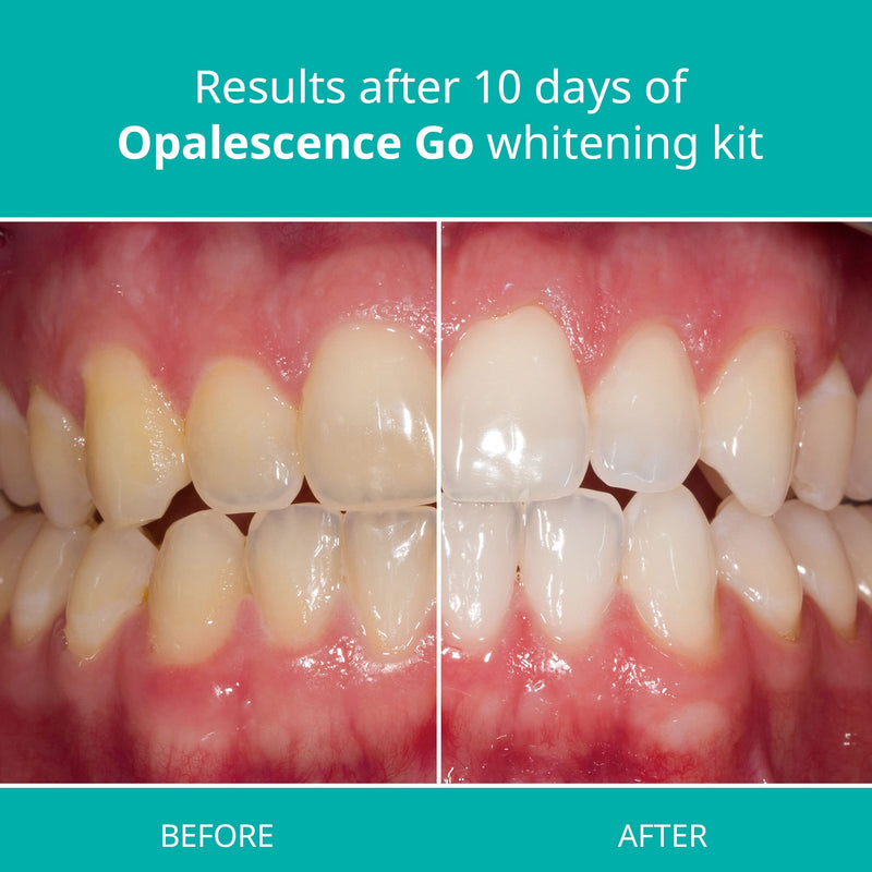 Opalescence Go - Prefilled Teeth Whitening Trays - 15% Hydrogen Peroxide - Mint - NewNest Australia