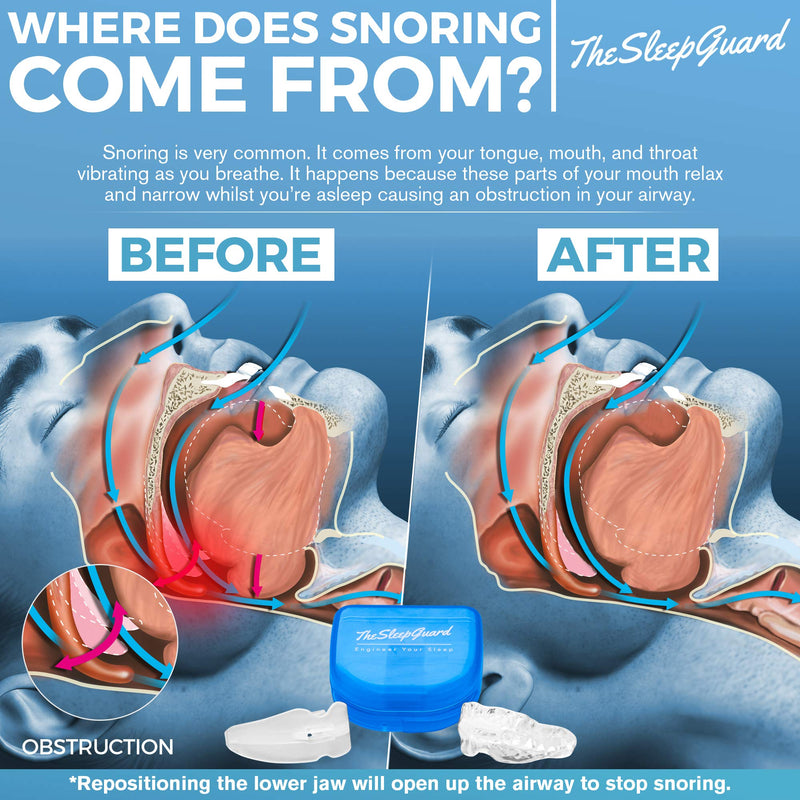 TheSleepGuard | Stop Snoring Solution Mouth Guard x1 | Sleep Aid and Snore Stopper | Best Anti Snoring Device, Mouthpiece & Gum Shield | Anti Snore Relief | Restful Sleep at Night for Men and Women - NewNest Australia