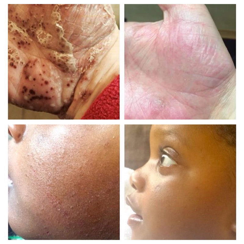Eczema Cream for dry, sensitive skin prone to eczema and psoriasis. Suitable for baby, children and adults. Fragrance free, natural and organic itch relief - NewNest Australia