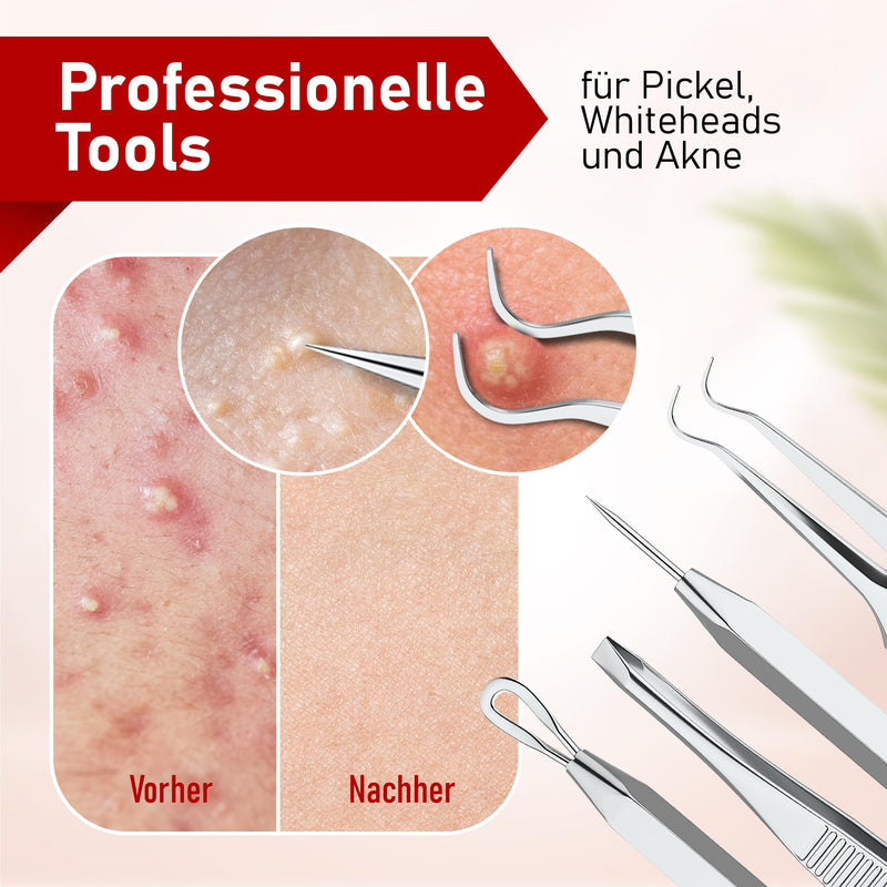 Neumann Blackhead Remover Set (Stainless Steel) For Removing Pimples, Blackheads Etc. - Comedone Squeezer, Lifter, Remover - Various Tools: Loops, Tweezers, Lancet [Silver] - NewNest Australia