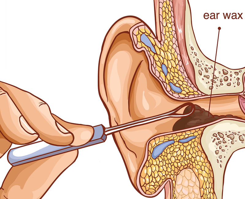 REMOS ear loop stainless steel for removing earwax, 7 cm long, satin - NewNest Australia