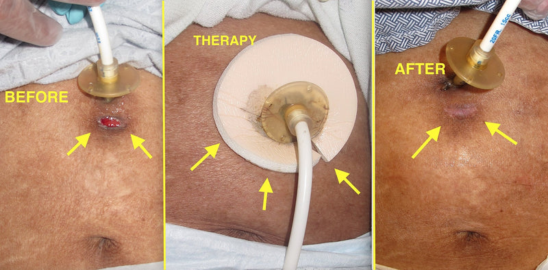 Ostomy Site Dressing: Silicone Foam (Round) May Help Secure Ostomy Tubes, Absorb Leakage, and Reduce Irritation Around Ostomies; 5 Per Box - NewNest Australia